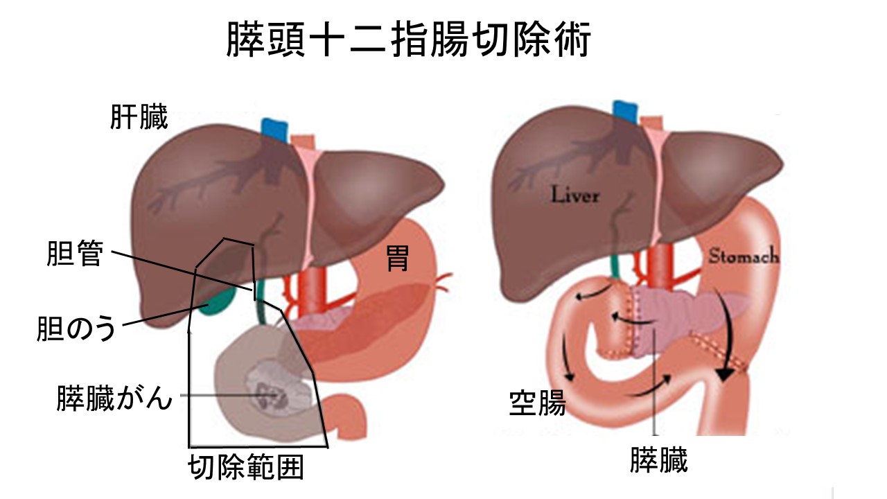 幽門狭窄の診断