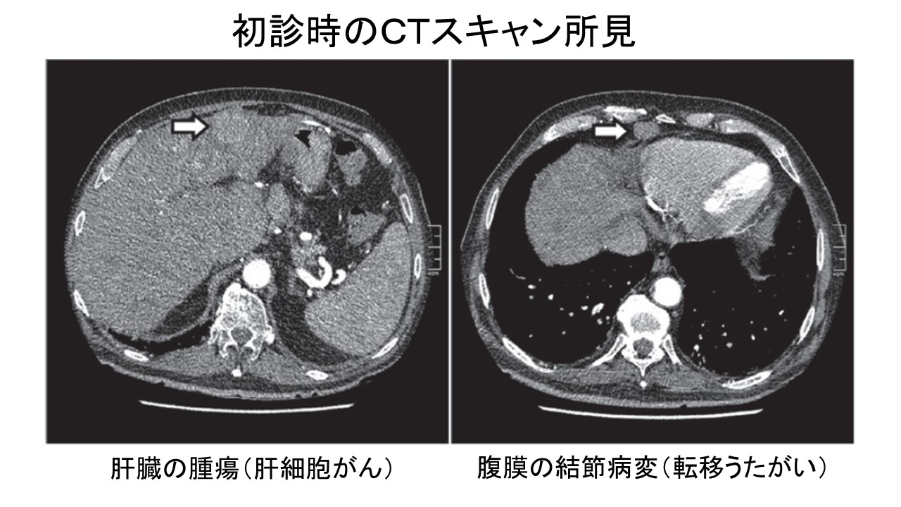 肝細胞がん自然退縮例CT初診時