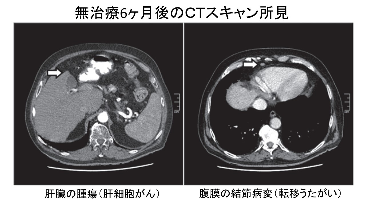 肝細胞がん自然退縮例CT６ヶ月後