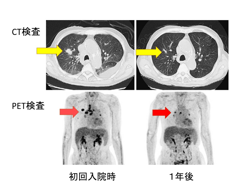 肺がん自然退縮 画像検査