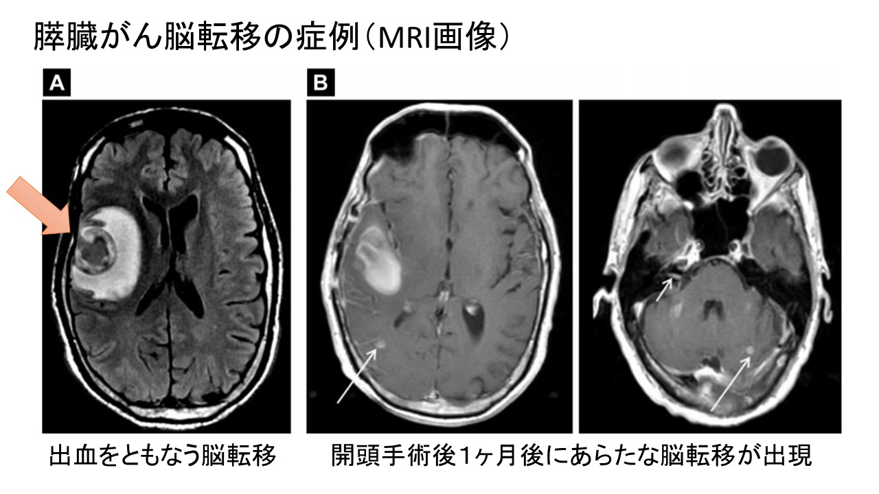 膵臓がん脳転移症例MRI